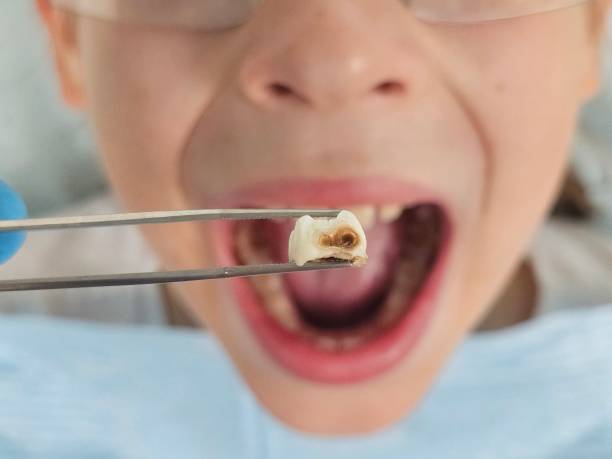 Best Emergency Treatment for Dental Infections or Abscesses in Five Forks, SC